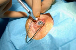 injection oeil